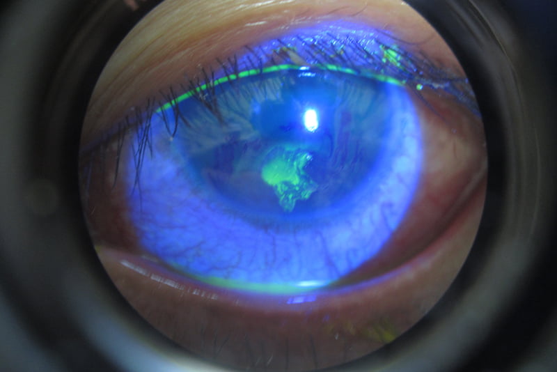 What Causes Corneal Erosion Syndrome