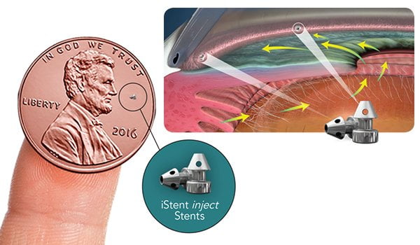 Minimally Invasive Glaucoma Surgery Migs Top Vision Eye Specialist Centre 